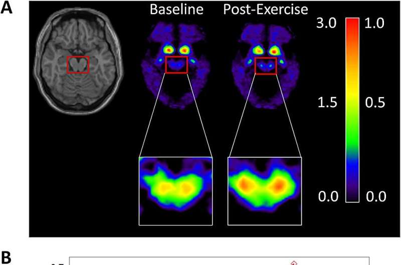 High-intensity exercise can reverse neurodegeneration in Parkinson's