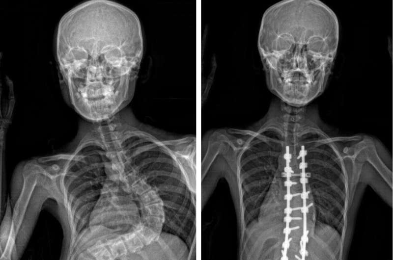 HKUMed researchers uncover key genetic clue in adolescent idiopathic scoliosis