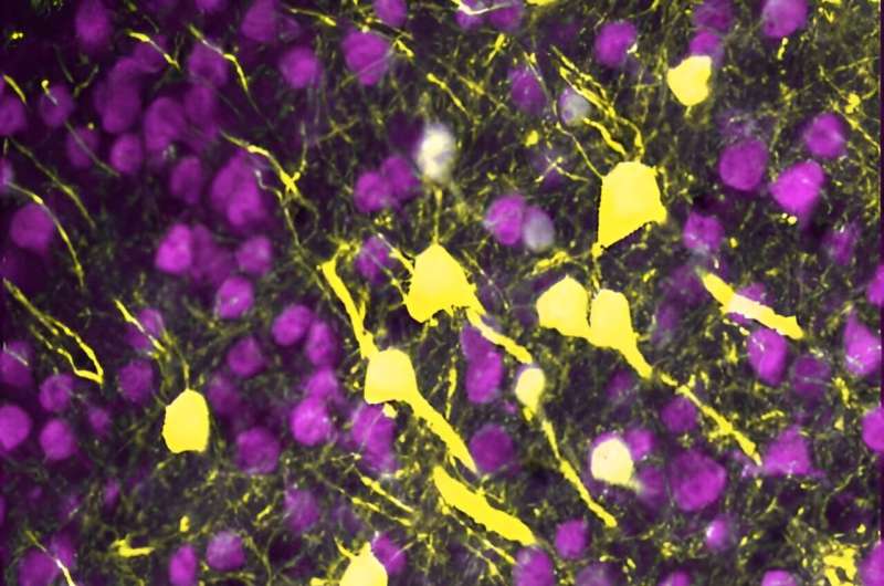How the inflamed brain becomes disconnected after A stroke