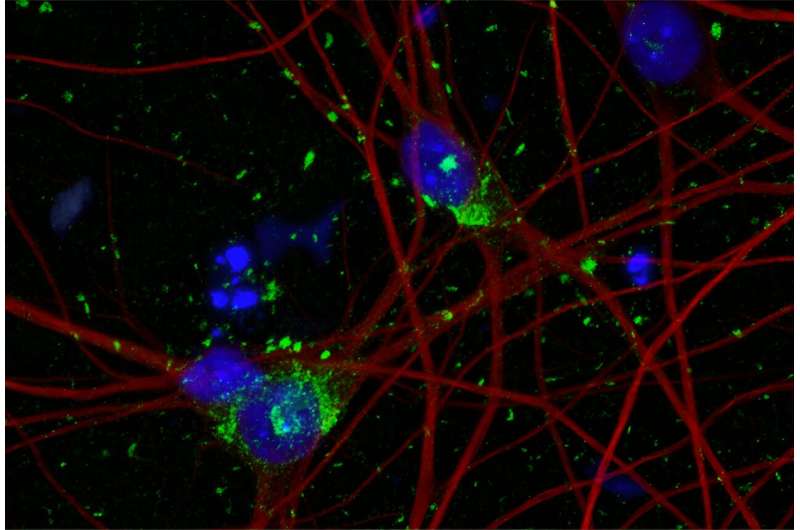 Human neuron model paves the way for new Alzheimer's therapies
