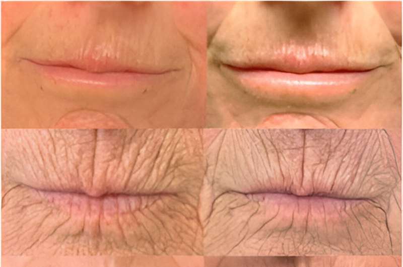 Hyaluronic acid lip fillers safe for patients with systemic sclerosis, study finds