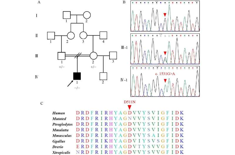 Identification of a novel MYO1D variant associated with laterality defects, congenital heart diseases, and sperm defects in humans