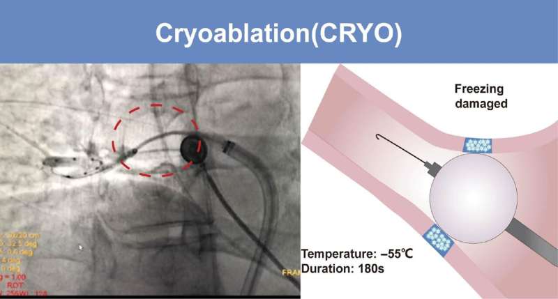 Incremental metabolic benefits from cryoablation for paroxysmal atrial fibrillation