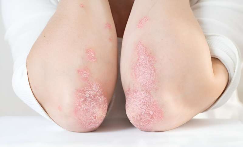 JNJ-77242113 shows greater efficacy than placebo for plaque psoriasis