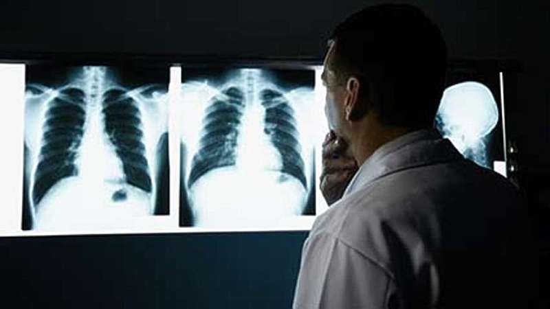 Just 18% of people who need lung cancer screening get it