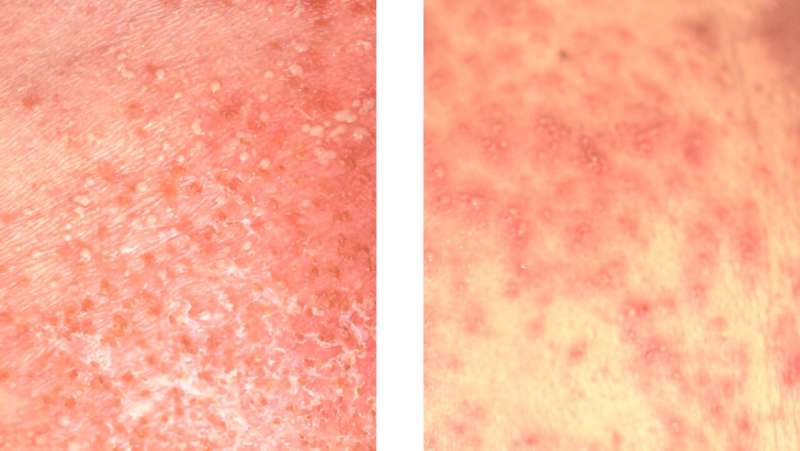 Keeping score: novel method might help differentiate 2 serious skin diseases