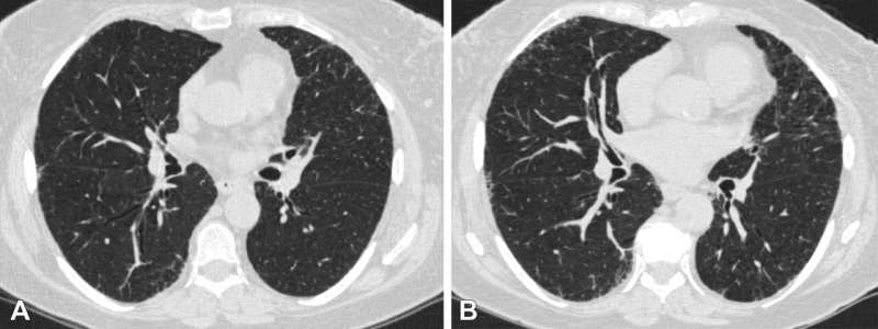 Lung abnormality progression linked to acute respiratory disease in smokers