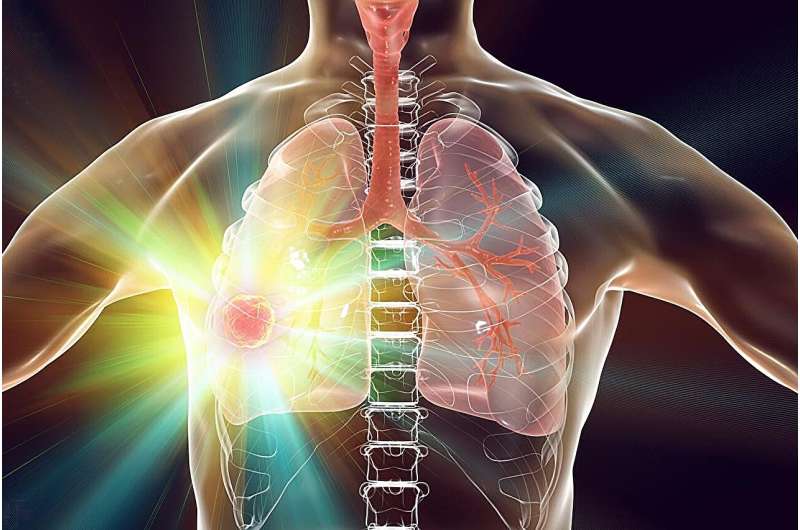 Lung complications + rheumatoid arthritis increase risk for lung cancer