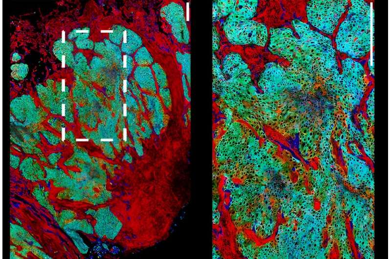 Mapping the evolution of urinary tract cancer cells