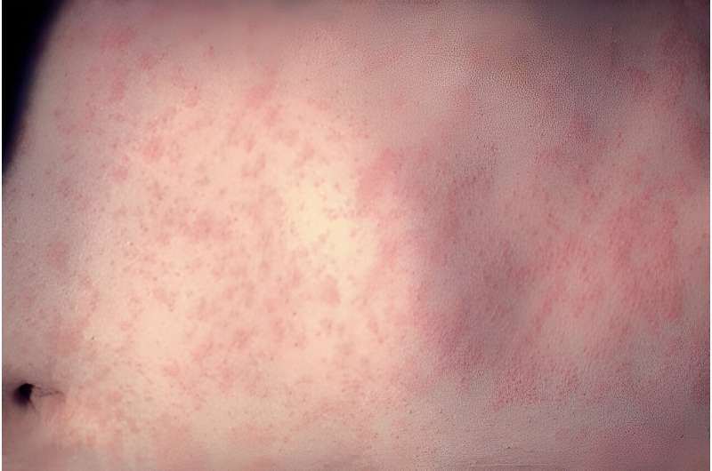 Measles is one of the deadliest and most contagious infectious diseases—and one of the most easily preventable