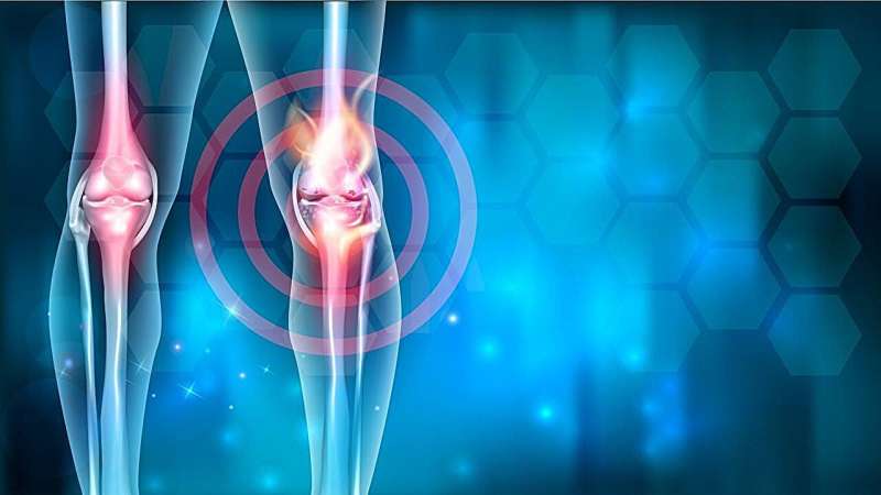 Methotrexate beneficial for reducing pain, stiffness in knee osteoarthritis