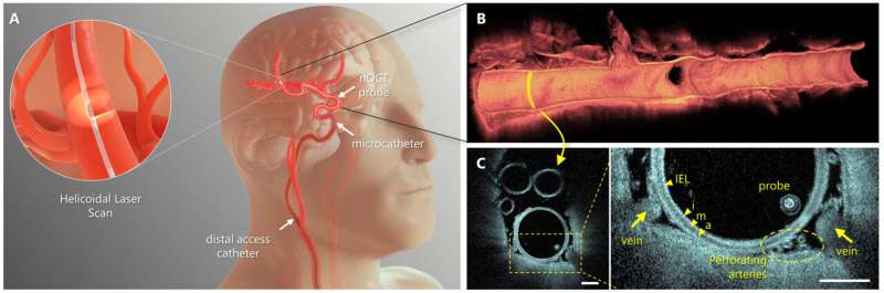 Miniaturized optical coherence tomography imaging probe takes pictures inside of brain arteries