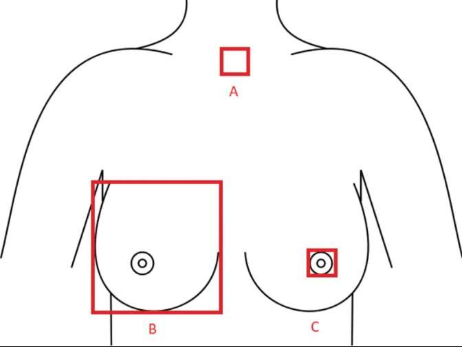 Neural network enables objective assessment of breast symmetry