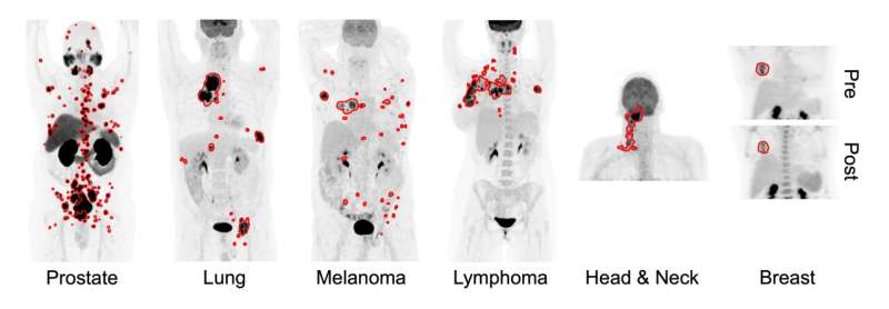 New AI tool accurately detects six different cancer types on whole-body PET/CT scans