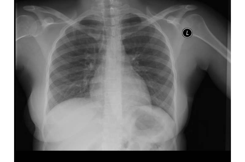 New AI tool accurately detects COVID-19 from chest X-rays