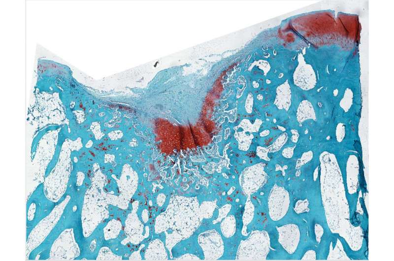 New biomaterial regrows damaged cartilage in joints