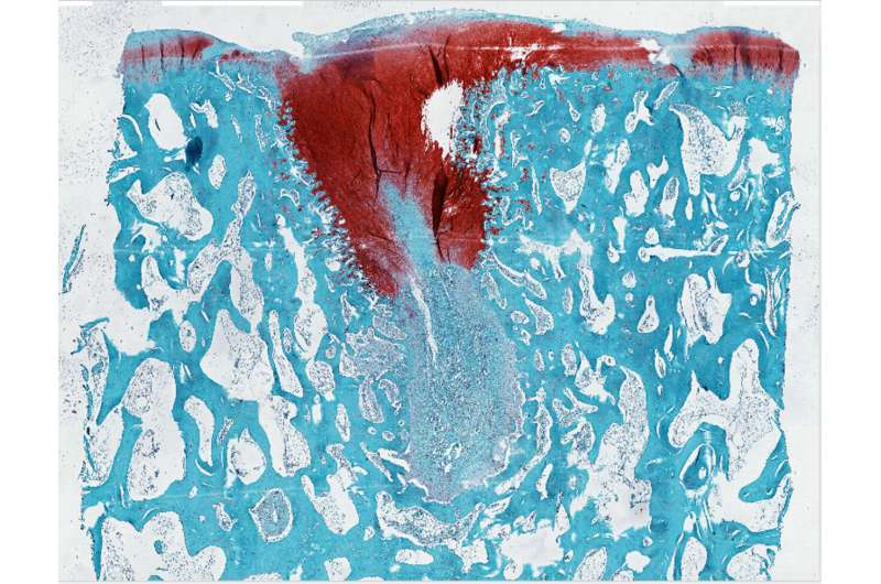 New biomaterial regrows damaged cartilage in joints