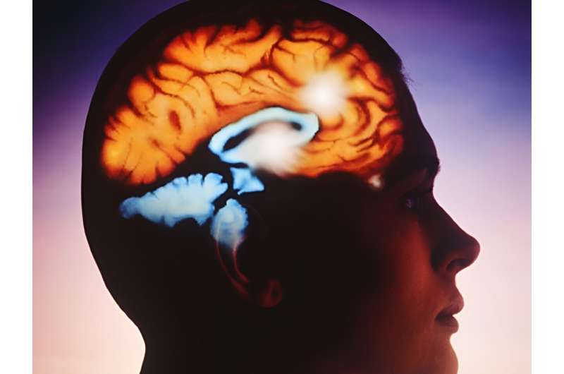 New brain target key to easing tough-to-treat epilepsy