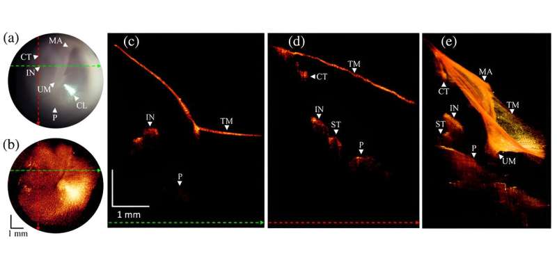 New imaging device improves ear disease diagnosis