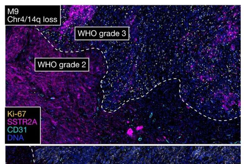 New mechanisms underlying tumor variety in brain cancers discovered