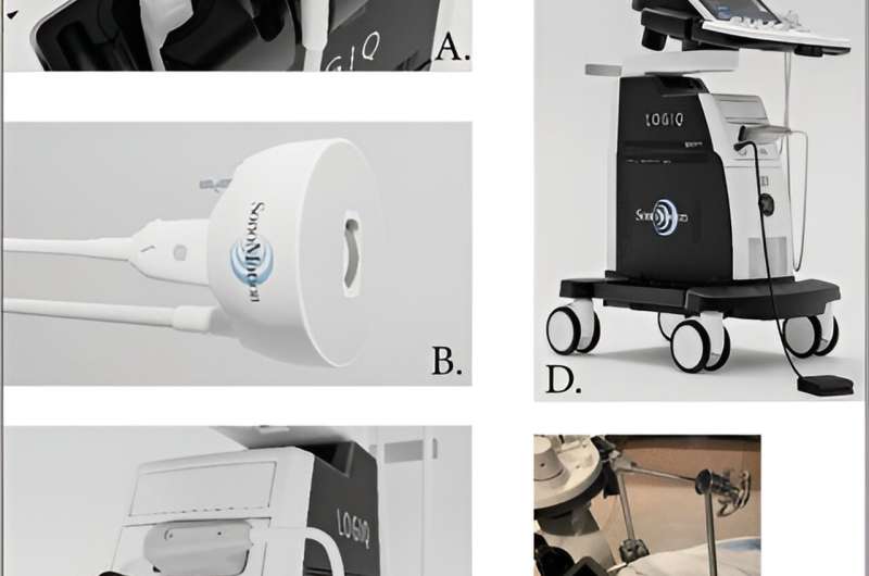 New noninvasive technique provides effective treatment for urinary stones