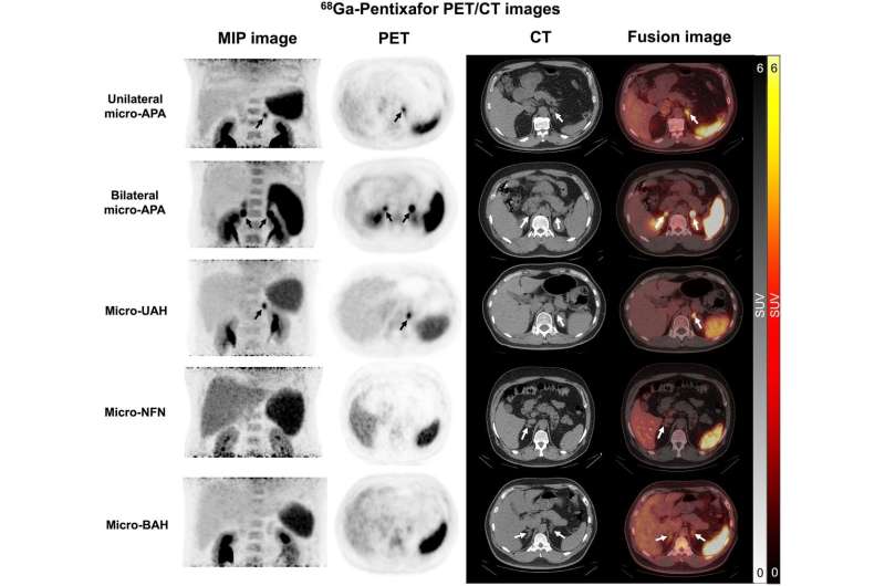 New PET/CT technique accurately diagnoses adrenal gland disorder, informs personalized treatment plans