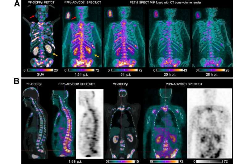 New SPECT/CT technique shows impressive biomarker identification, offers increased access for prostate cancer patients