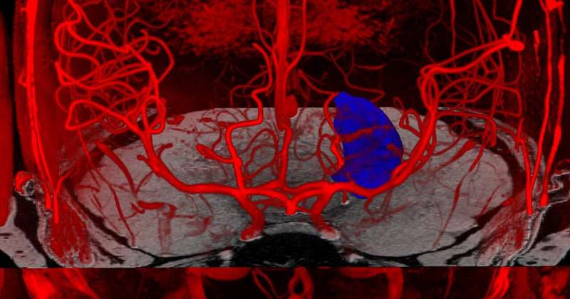 New study expands understanding of brain blood flow and neurological disorders