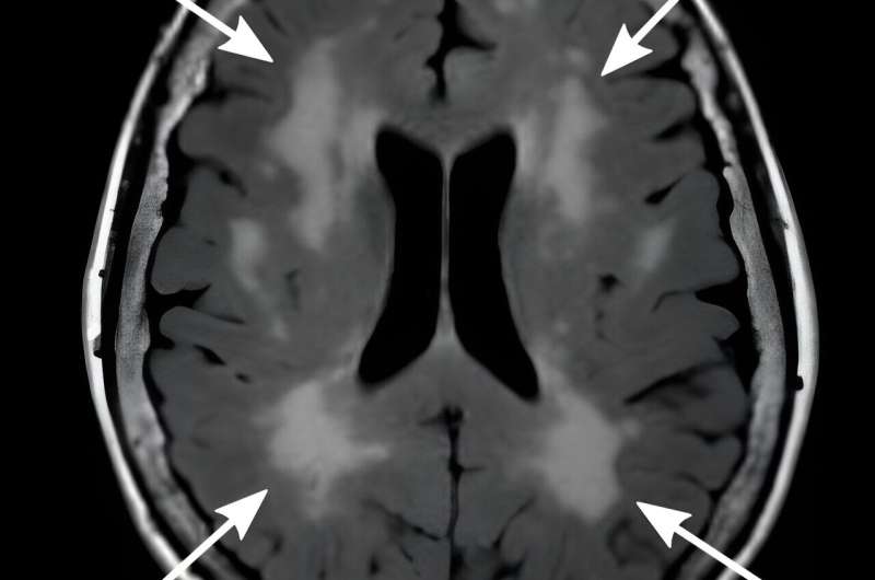 New study reveals age-related brain changes influence recovery after stroke