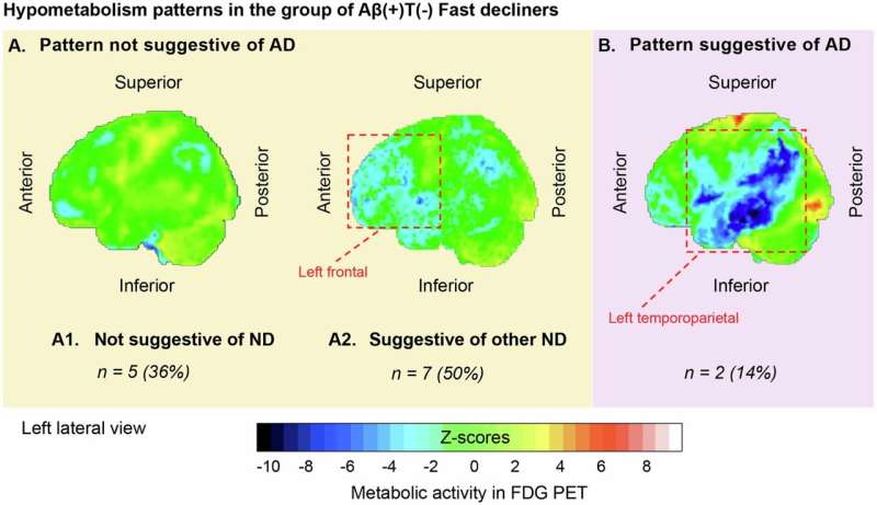 New study sheds light on Alzheimer's disease progression