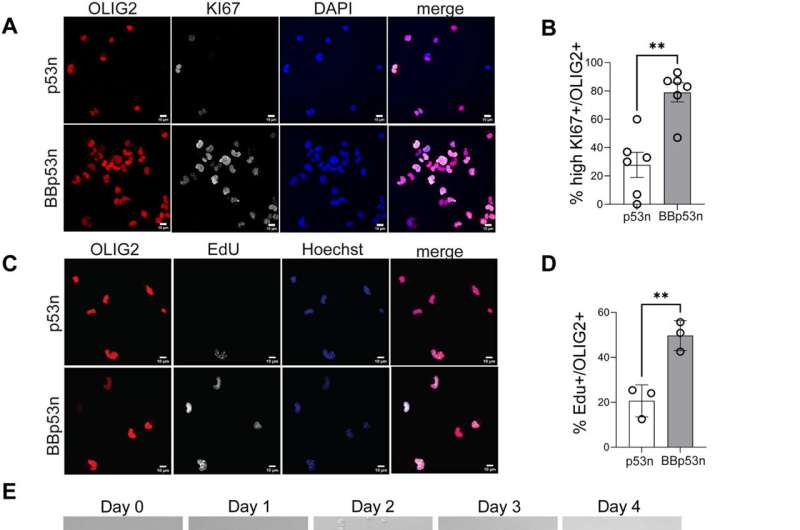 New study uncovers key mechanisms responsible for the transformation of adult progenitors into brain tumors