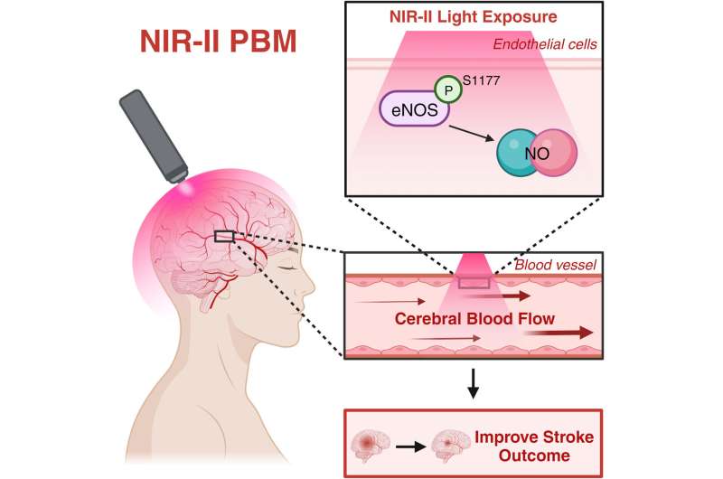 Noninvasive laser therapy could be an effective new treatment for stroke patients