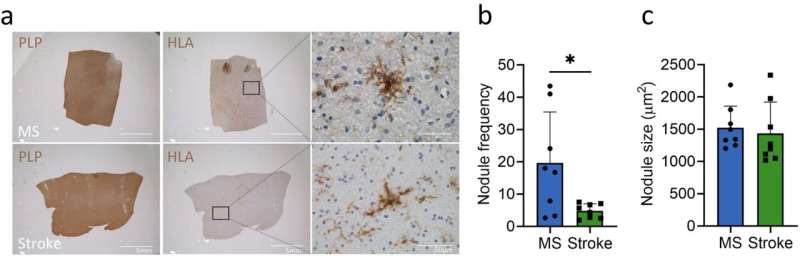 Normal-appearing tissue offers insights into lesion formation in Multiple Sclerosis