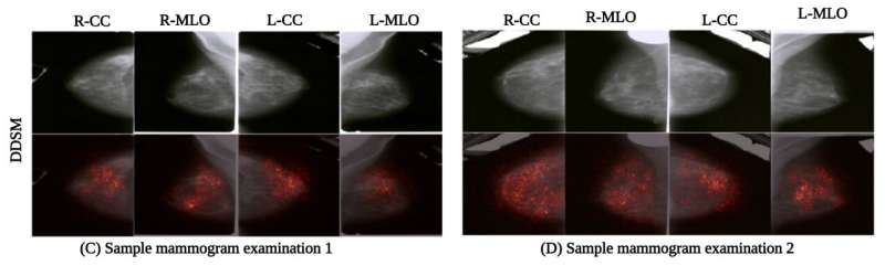 Novel AI algorithm assists in breast cancer screening