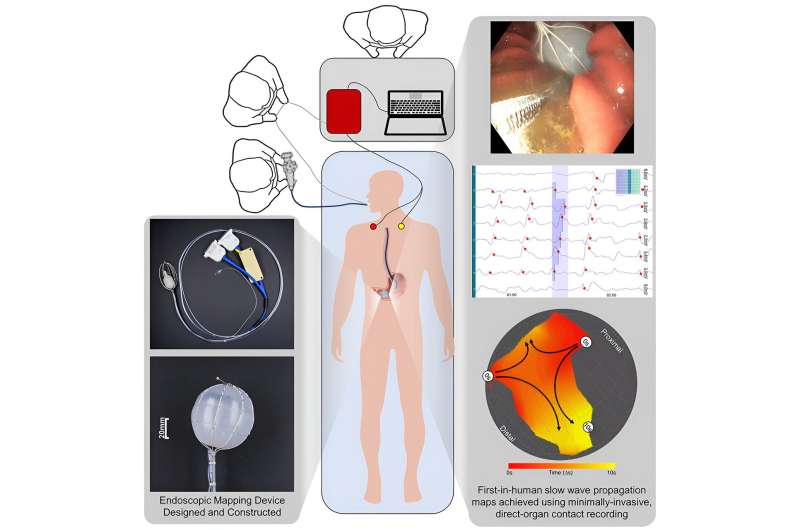 Novel device for stomach complaints is successful in human trial