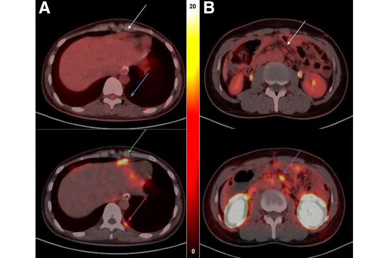 Novel radiotracer rapidly detects gastrointestinal cancer biomarker, identifies patients for targeted therapy