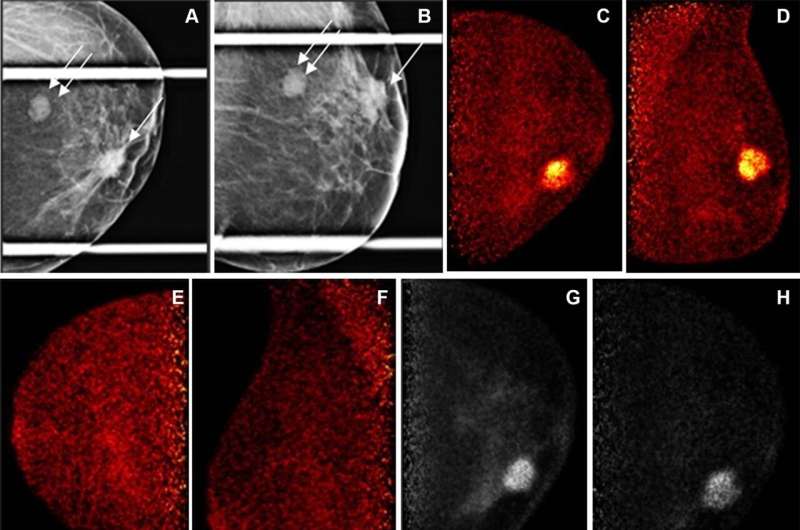 Novel technique has potential to transform breast cancer detection