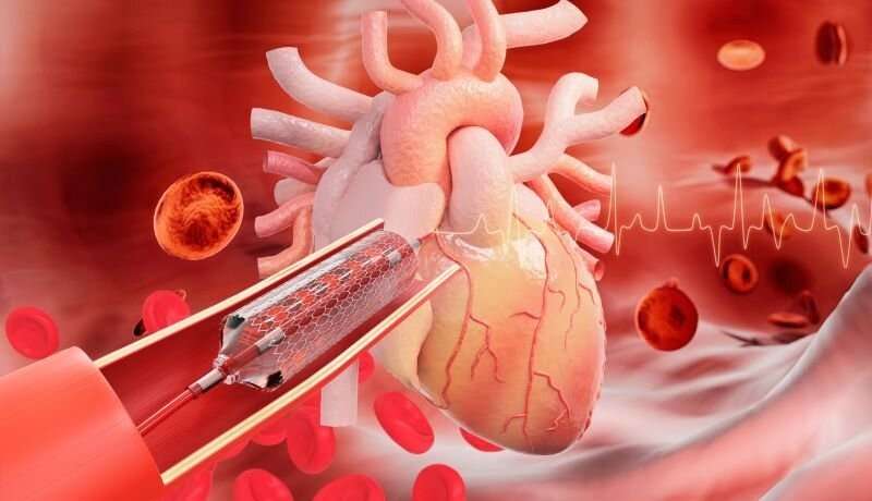 Paclitaxel-coated balloon effective for coronary in-stent restenosis