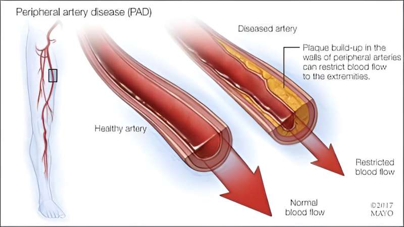 Peripheral artery system at risk of disease due to family history, lifestyle