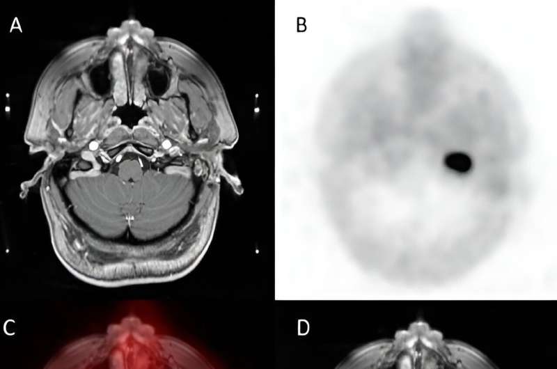 PET/CT provides superior lesion detection for head and neck paragangliomas compared to gold standard MRI