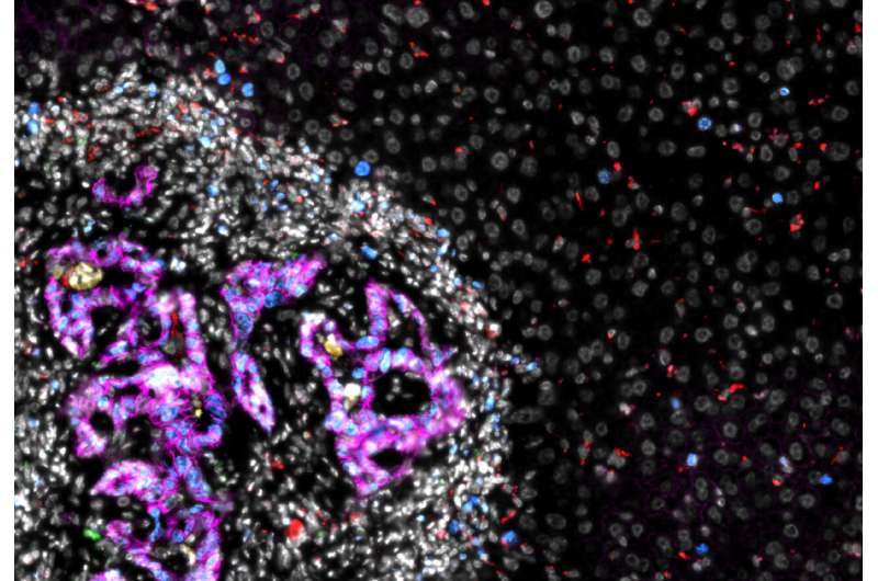 Preventing cancer cells from colonizing the liver