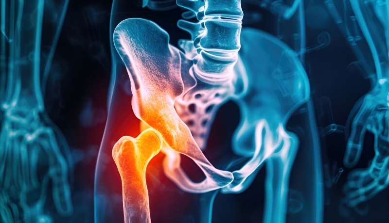 Progressive resistance training not superior for hip osteoarthritis