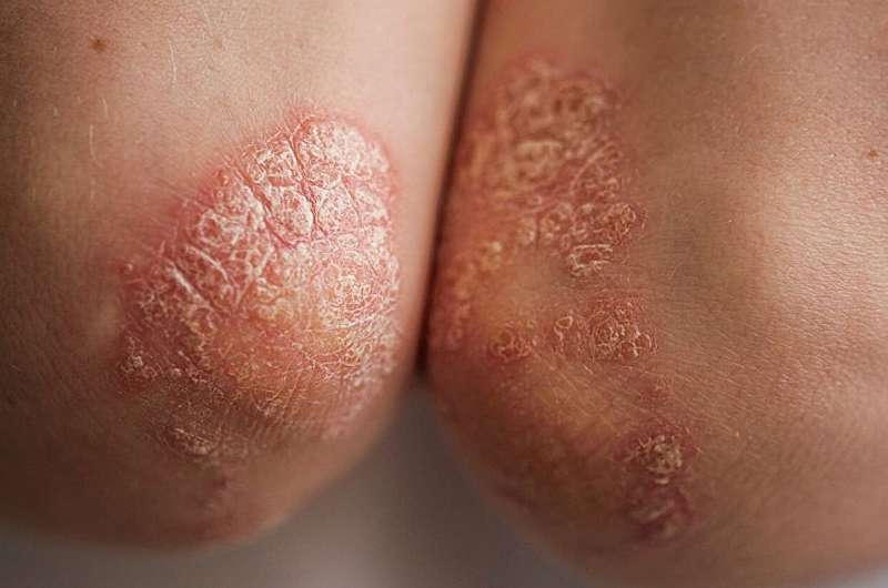 Psoriasis, psoriatic arthritis tied to higher risk of polyneuropathy