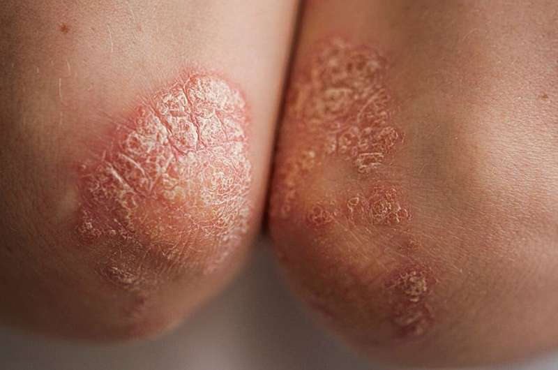 Psoriasis, with or without psoriatic arthritis, associated with fatigue