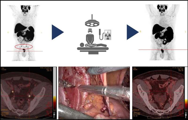 Radioguided surgery accurately detects and removes metastatic lymph nodes in newly diagnosed prostate cancer patients