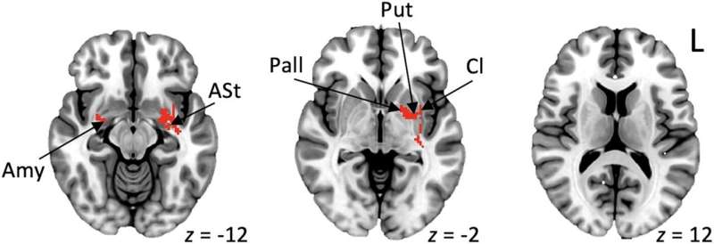 Research identifies brain network link to stuttering