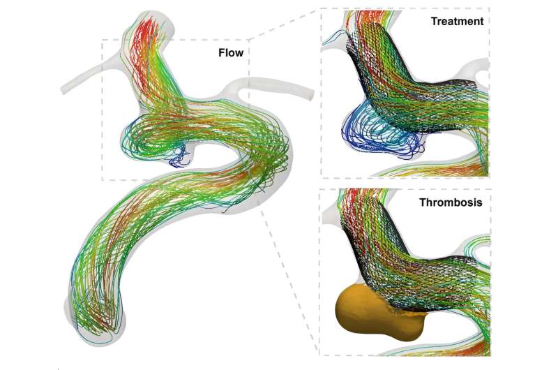 Research progress reveals faster, more accurate blood flow simulation to revolutionise treatment of vascular diseases