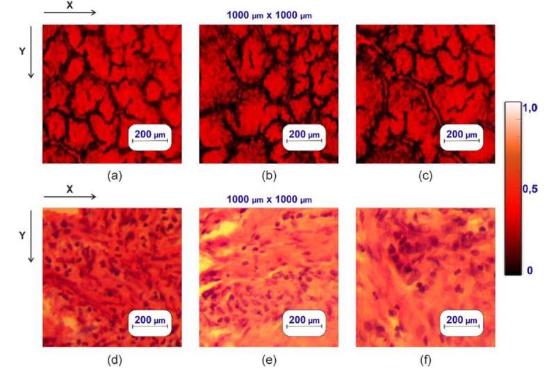 Researcher uses light to develop faster, cheaper and less painful technique to detect prostate cancer