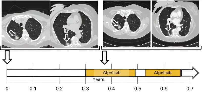 Researchers develop mechanism that predicts severity of aggressive form of breast cancer