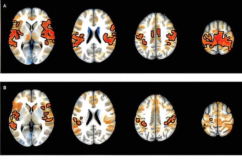 Researchers identify brain connections associated with ADHD in youth